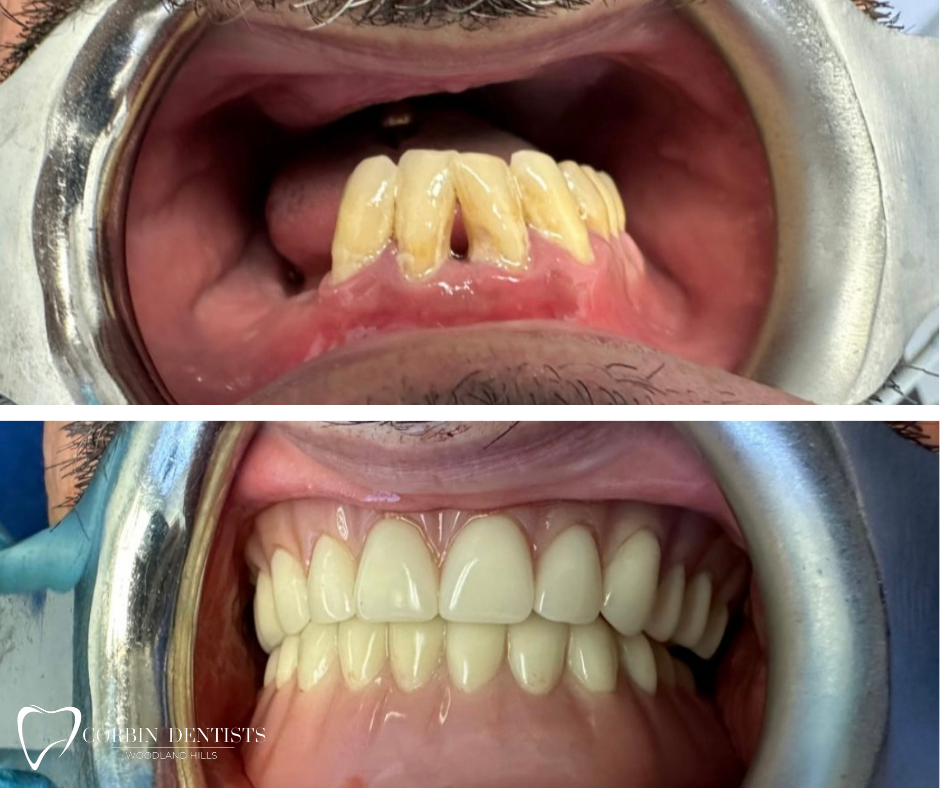 Dental Implant & Crown Before & After