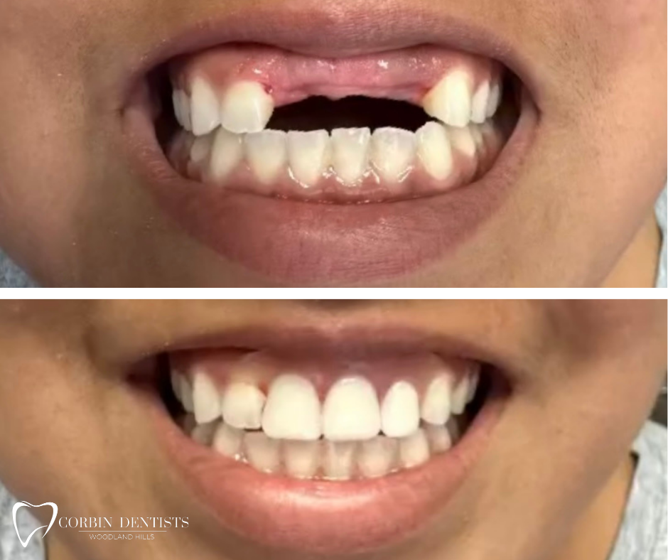 Smile Design Before & After