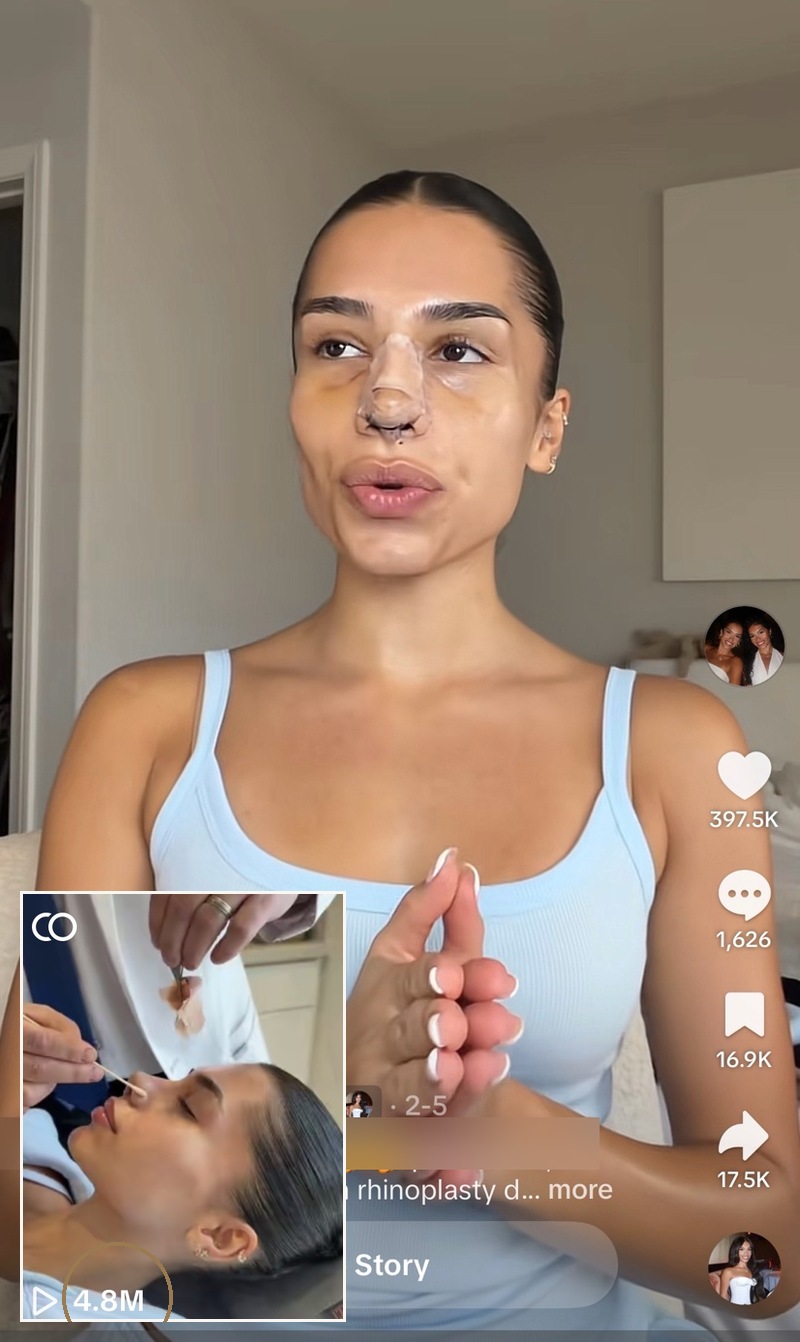 Rhinoplasty Reveal Collab - TikTok Influencer